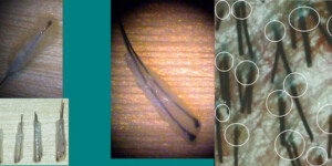 Τριχοθυλάκια - PSHair - Hair Loss Clinic by PSMEDICAL - Μεταμόσχευση Μαλλιών FUE