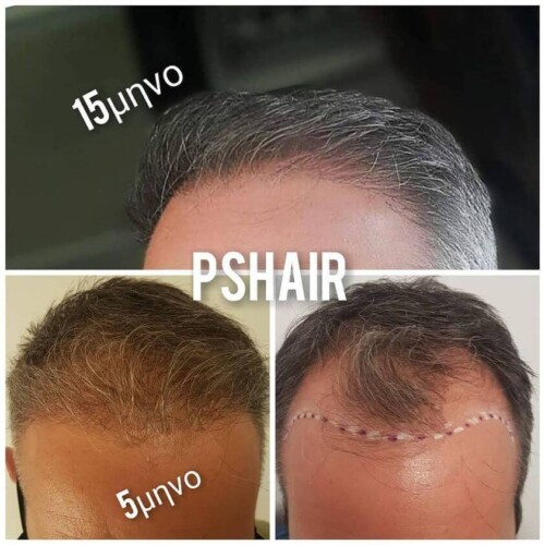 PSHair - Hair Loss Clinic by PSMEDICAL - Μεταμόσχευση Μαλλιών FUE